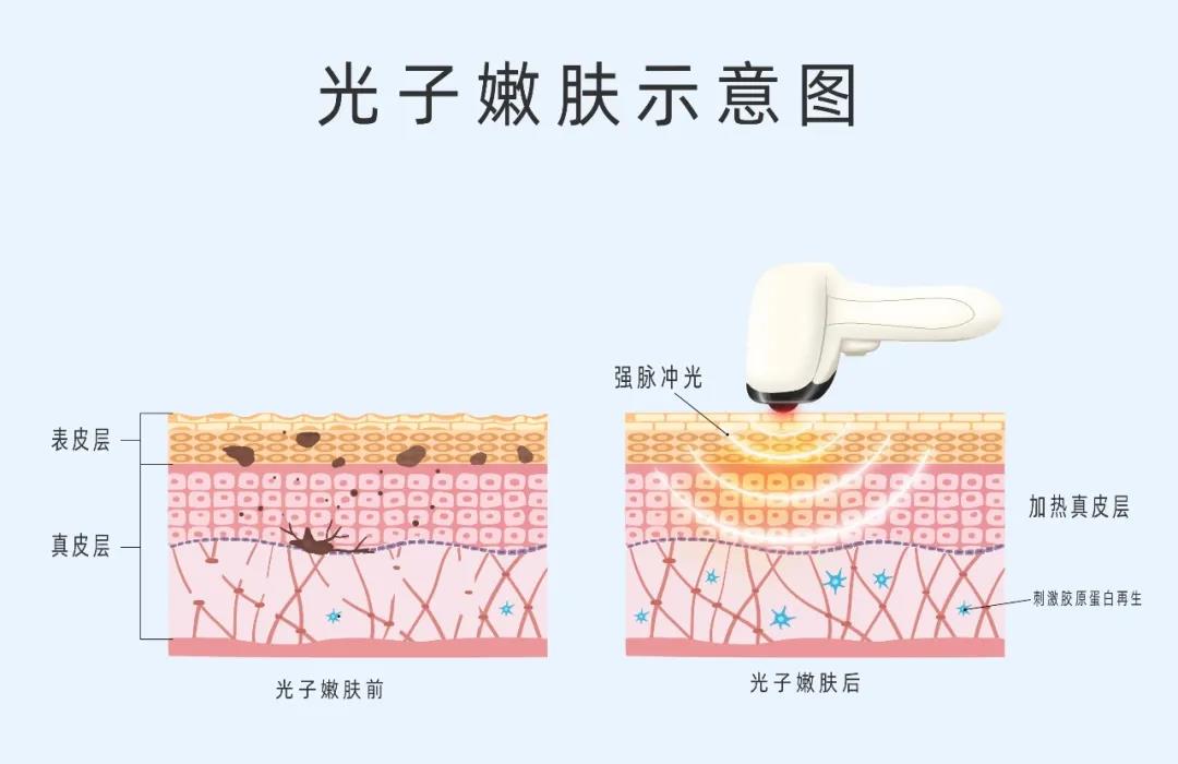 做好術(shù)后修復(fù)，拒絕“無效醫(yī)美”